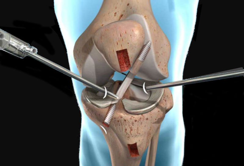 Loan for ACL surgery in Perth.